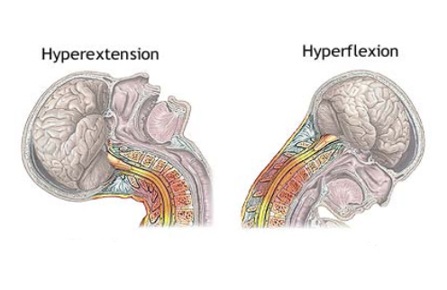 hyperflexion-hyperextension-cervicale