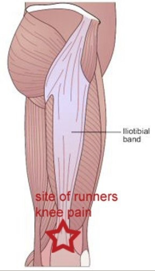 syndrome-essuie-glace-osteo