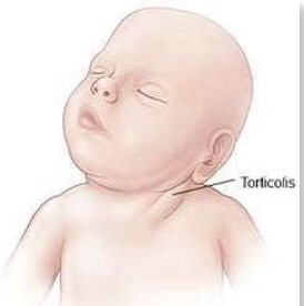 causes-deformations-torticolis-congenital