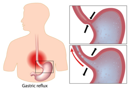 traitement-osteo-reflux-gastrique-femme-enceinte